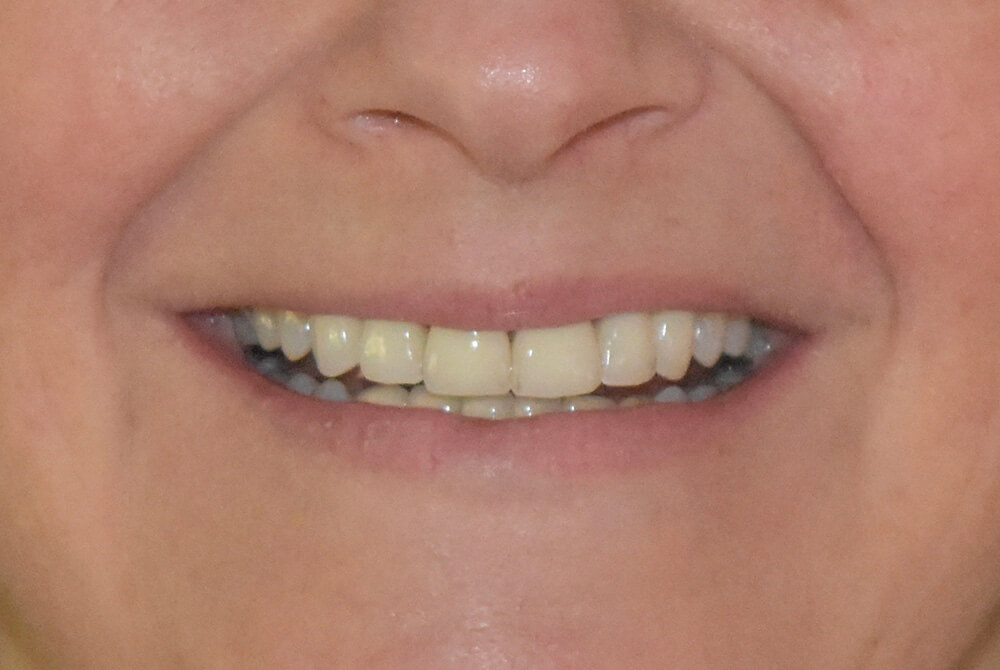 Dental32-Before-After-bf