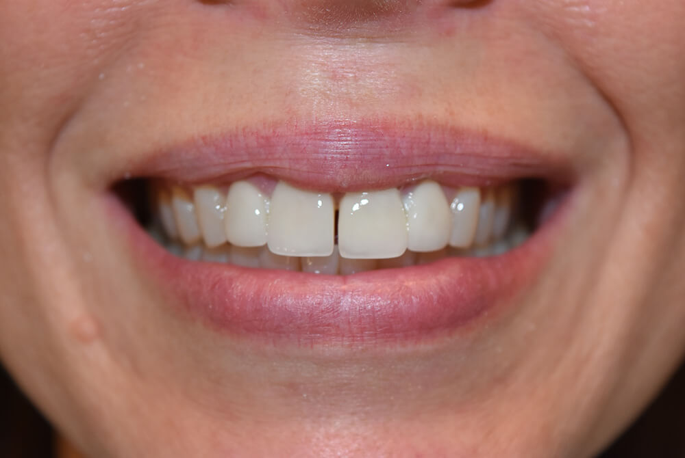 Dental32-Before-After-mj