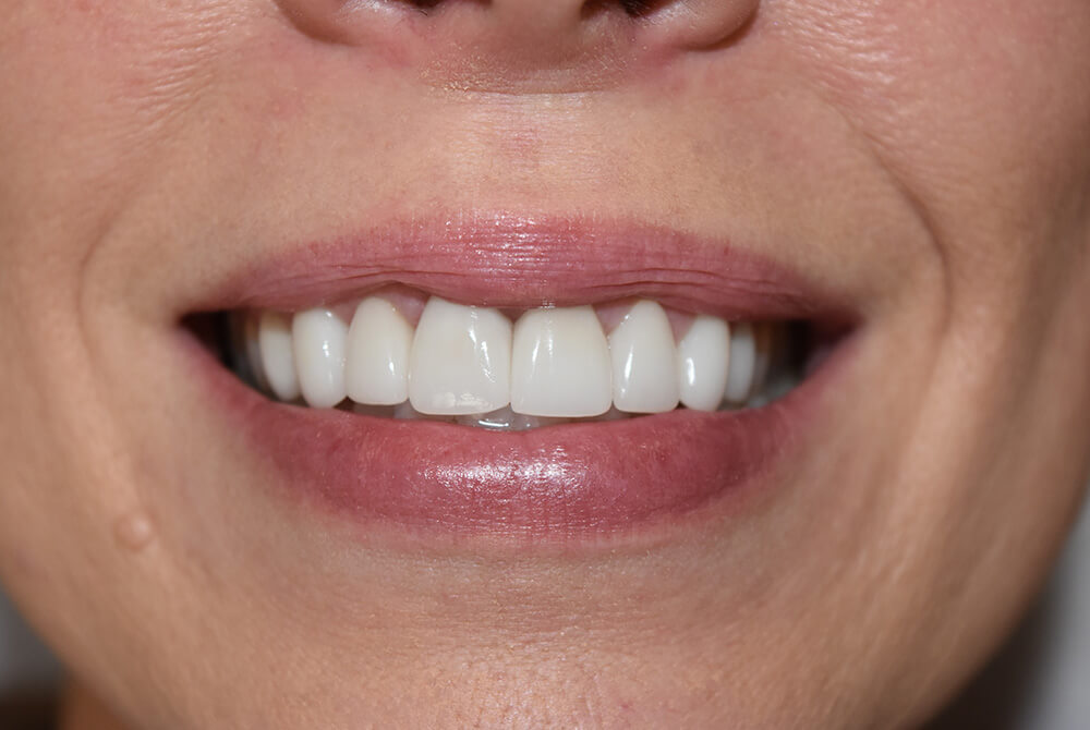 Dental32-Before-After-mj2