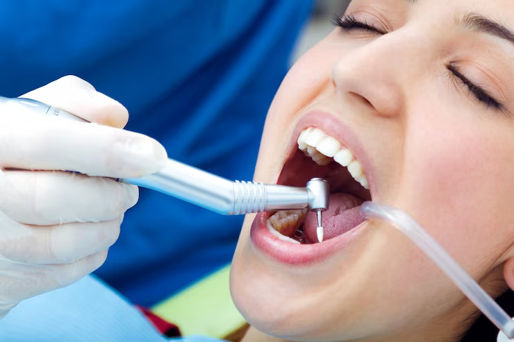 Tooth Extractions in Kennesaw GA